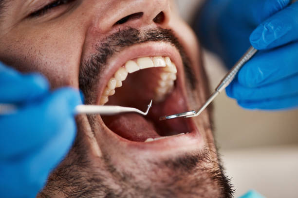 Best Knocked-Out Tooth (Avulsed Tooth) Treatment in Macdonnell Heights, NY